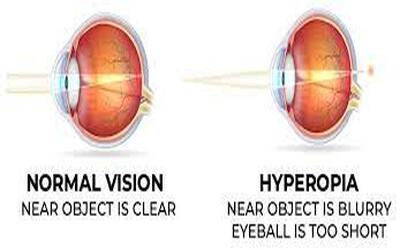 Farsightedness Caused and Corrected: A Comprehensive Guide