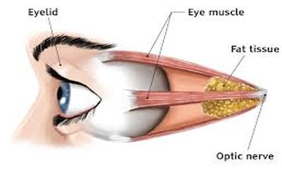 Thyroid Eye Disease: Unraveling Causes and Exploring Treatment Options