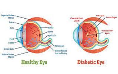 See the Warning Signs: Early Symptoms of Diabetic Retinopathy